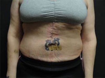 Body Reconstruction  Before & After Gallery - Patient 167358386 - Image 2