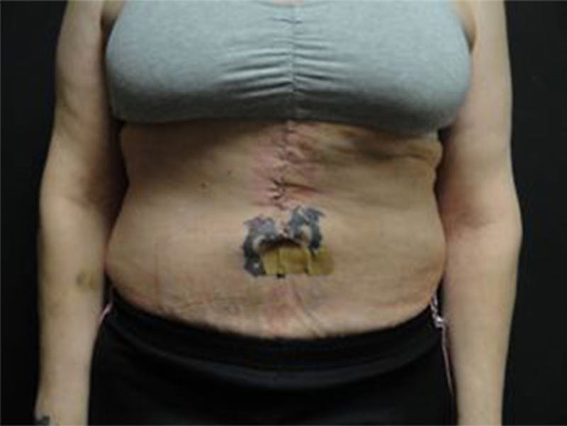 Reconstruction Before & After Gallery - Patient 167358386 - Image 2