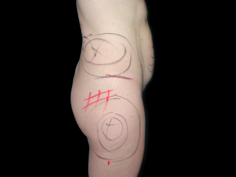Liposuction Before & After Gallery - Patient 167358373 - Image 5