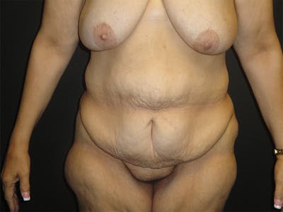 Body Lift Before & After Gallery - Patient 167367511 - Image 1