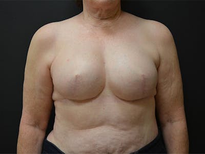 Breast Implant Reconstruction Before & After Gallery - Patient 167367509 - Image 2