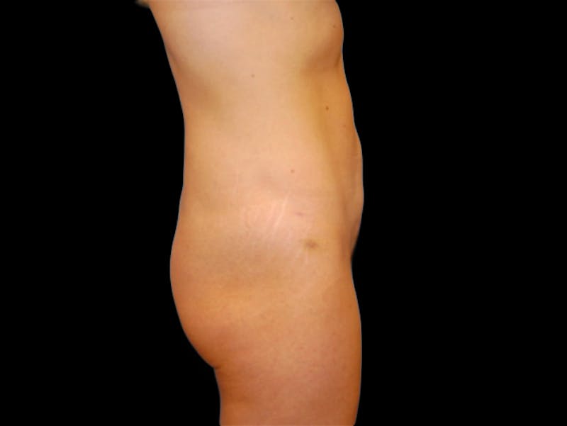 Liposuction Before & After Gallery - Patient 167358373 - Image 6