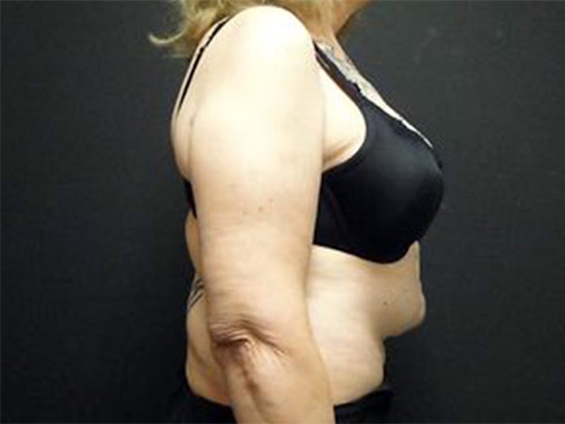 Reconstruction Before & After Gallery - Patient 167358386 - Image 3
