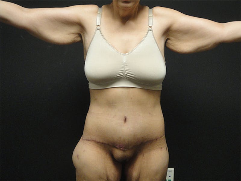 Body Lift Before & After Gallery - Patient 167367511 - Image 2