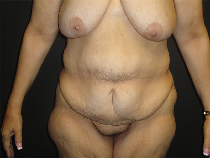 Tummy Tuck Before & After Gallery - Patient 167367512 - Image 1