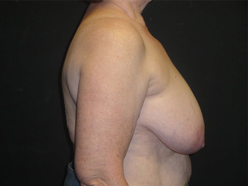 Breast Implant Reconstruction Before & After Gallery - Patient 167367509 - Image 3