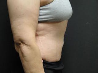 Body Reconstruction Before & After Gallery - Patient 167358386 - Image 4