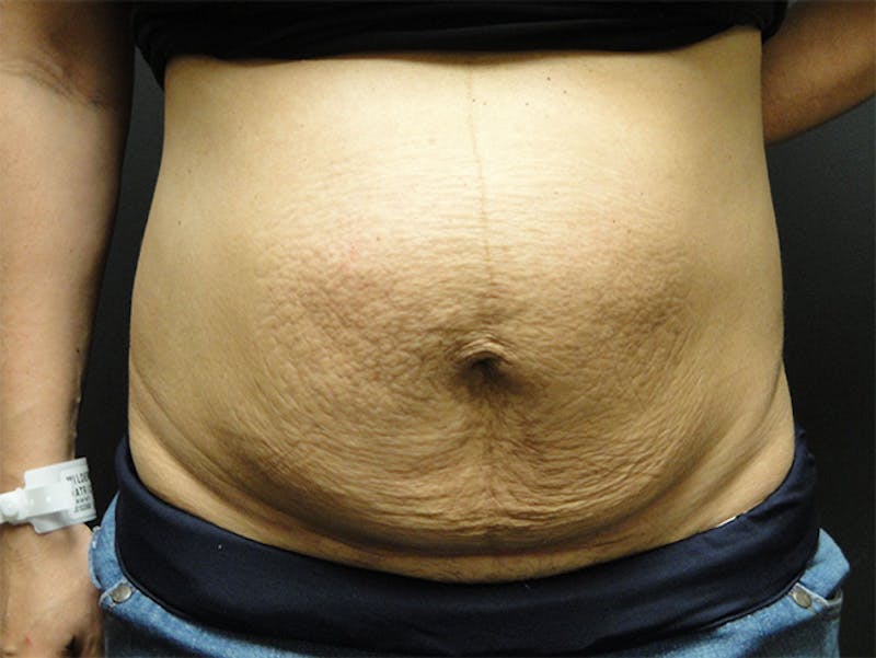 Liposuction Before & After Gallery - Patient 167367510 - Image 1