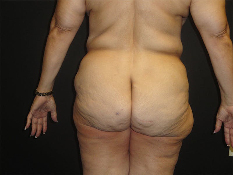 Body Lift Before & After Gallery - Patient 167367511 - Image 3
