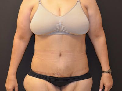 Tummy Tuck Before & After Gallery - Patient 167367512 - Image 2