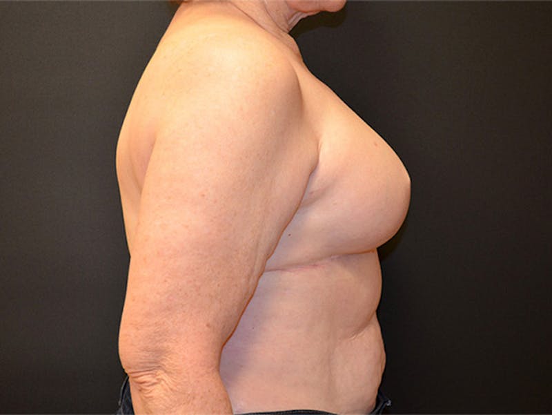 Breast Implant Reconstruction Before & After Gallery - Patient 167367509 - Image 4