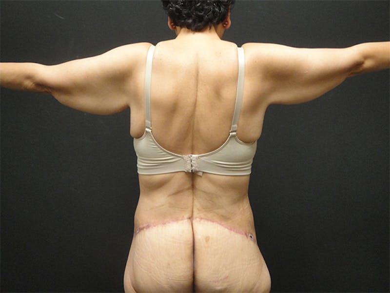 Body Lift Before & After Gallery - Patient 167367511 - Image 4