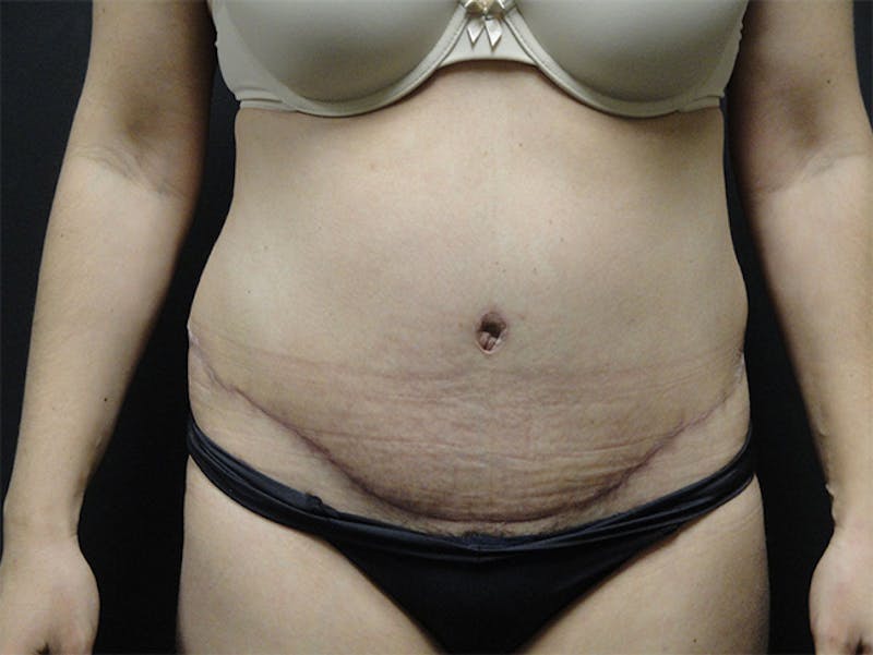 Liposuction Before & After Gallery - Patient 167367510 - Image 2