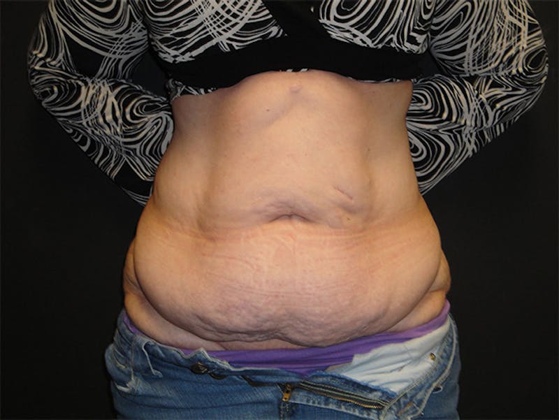 Reconstruction Before & After Gallery - Patient 167367516 - Image 1
