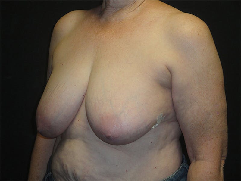 Breast Implant Reconstruction Before & After Gallery - Patient 167367509 - Image 5