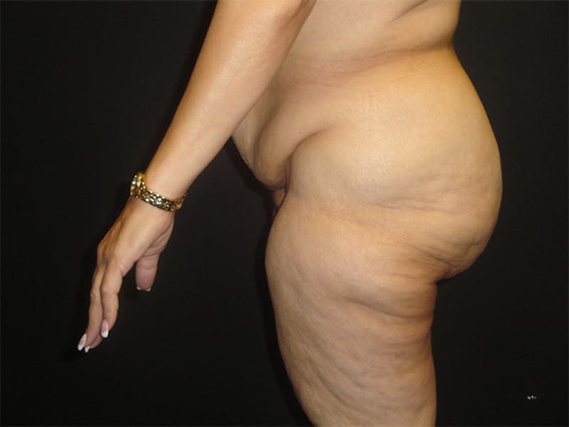 Body Lift Before & After Gallery - Patient 167367511 - Image 5