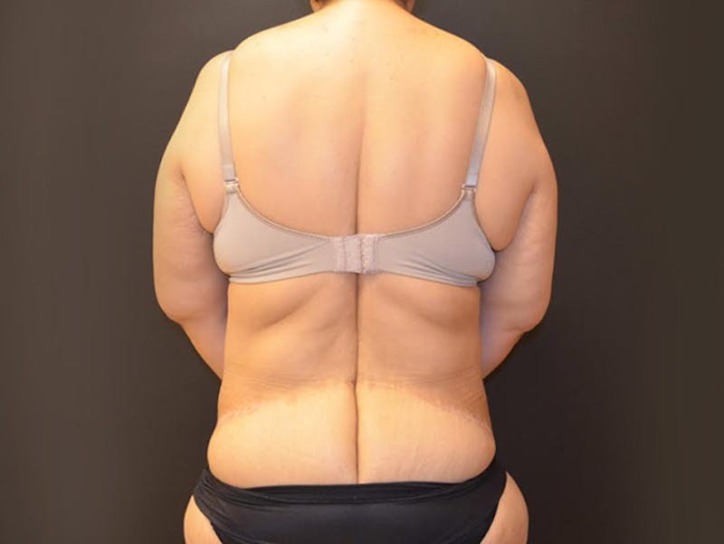Tummy Tuck Before & After Gallery - Patient 167367512 - Image 4