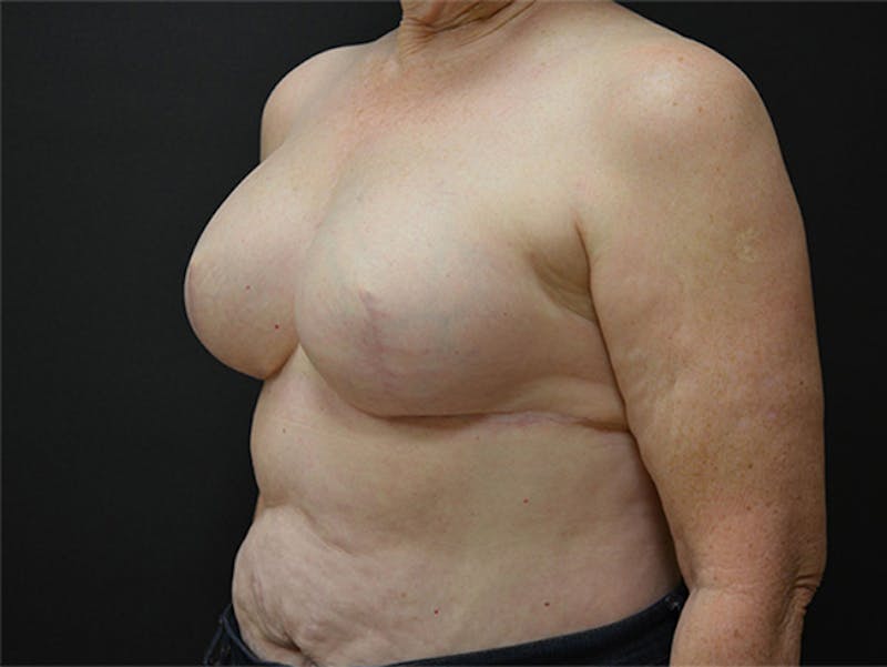 Breast Implant Reconstruction Before & After Gallery - Patient 167367509 - Image 6
