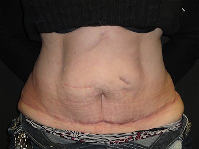 Body Reconstruction  Before & After Gallery - Patient 167367516 - Image 2