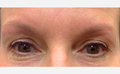 Microblading Before & After Gallery - Patient 167367513 - Image 1