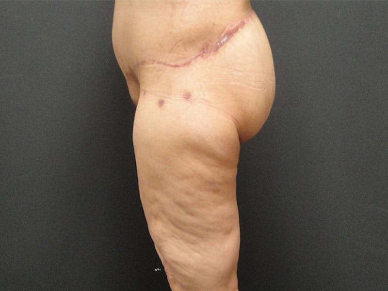 Body Lift Before & After Gallery - Patient 167367511 - Image 6
