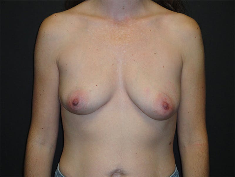Breast Implant Reconstruction Before & After Gallery - Patient 167367521 - Image 1