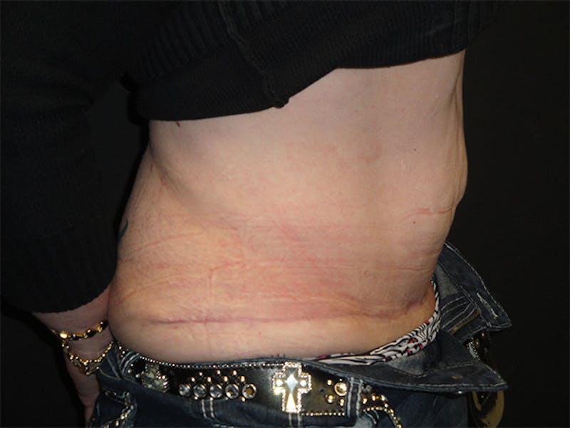Reconstruction Before & After Gallery - Patient 167367516 - Image 4