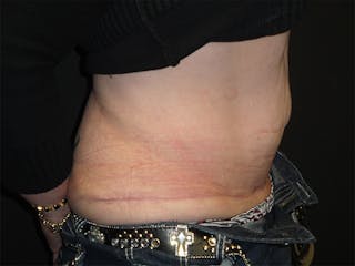 Body Reconstruction Before & After Gallery - Patient 167367516 - Image 4