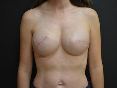 Breast Implant Reconstruction Before & After Gallery - Patient 167367521 - Image 2