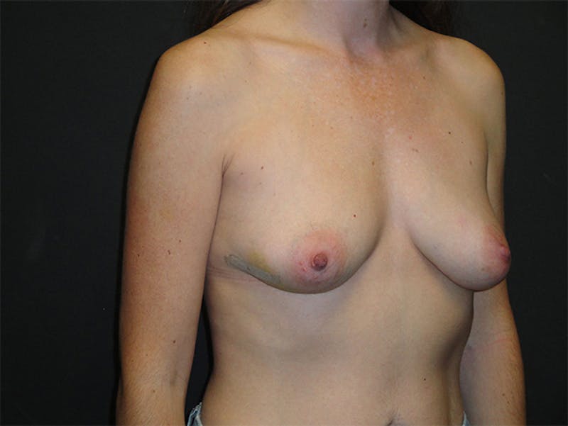 Breast Implant Reconstruction Before & After Gallery - Patient 167367521 - Image 3