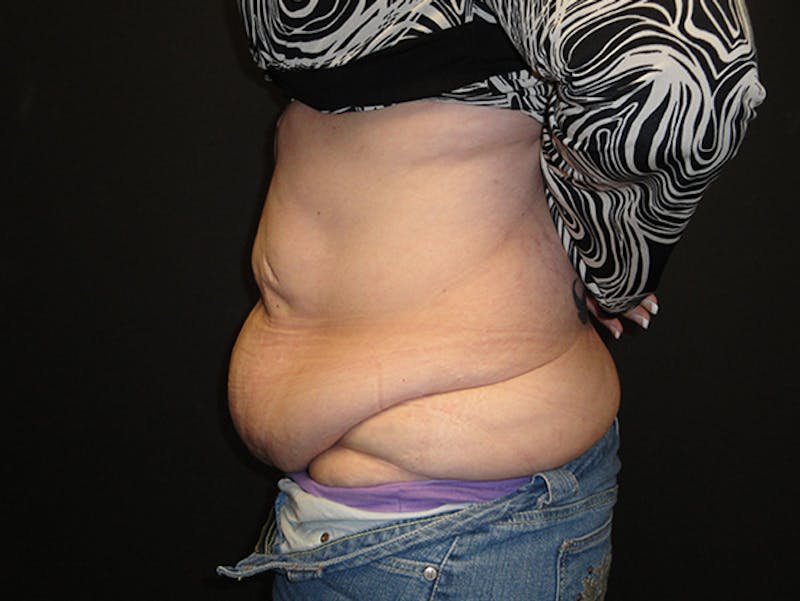 Reconstruction Before & After Gallery - Patient 167367516 - Image 5