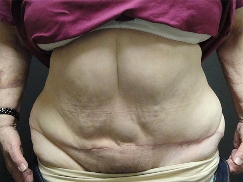 Tummy Tuck Before & After Gallery - Patient 167367535 - Image 2