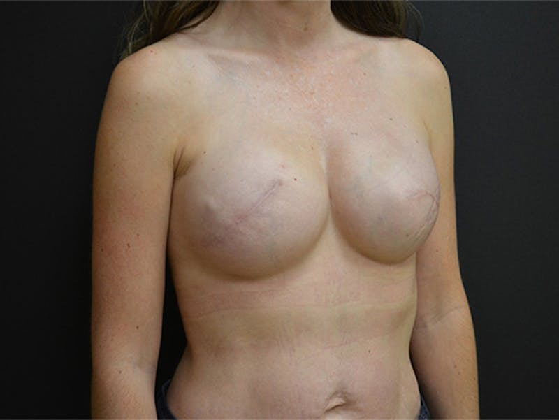 Breast Implant Reconstruction Before & After Gallery - Patient 167367521 - Image 4