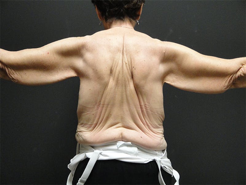 Body Lift Before & After Gallery - Patient 167367520 - Image 3