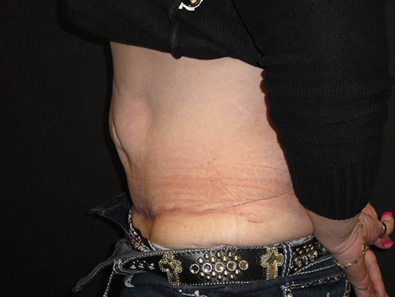 Reconstruction Before & After Gallery - Patient 167367516 - Image 6