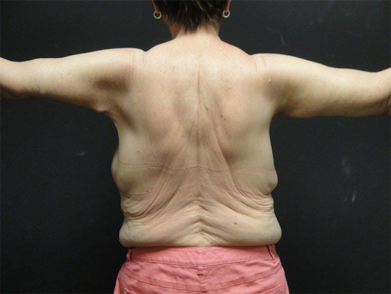 Body Lift Before & After Gallery - Patient 167367520 - Image 4