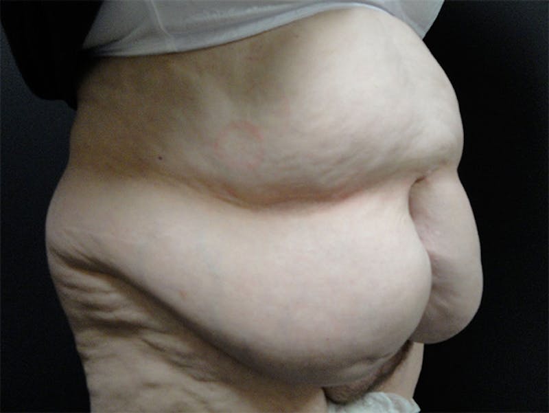 Tummy Tuck Before & After Gallery - Patient 167367535 - Image 3
