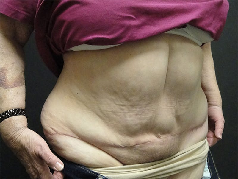 Tummy Tuck Before & After Gallery - Patient 167367535 - Image 4