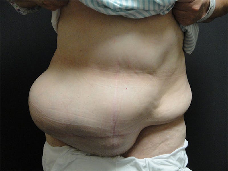 Body Reconstruction  Before & After Gallery - Patient 167367539 - Image 1