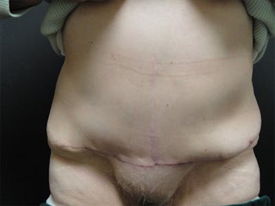 Body Reconstruction  Before & After Gallery - Patient 167367539 - Image 2