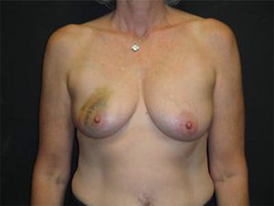 Breast Implant Reconstruction Before & After Gallery - Patient 167367538 - Image 1