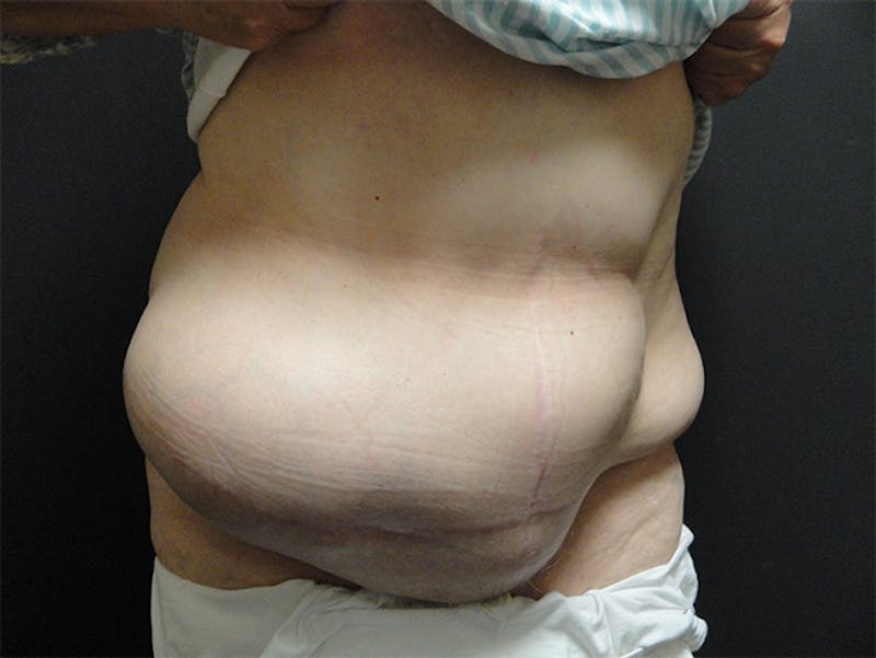 Body Reconstruction  Before & After Gallery - Patient 167367539 - Image 3