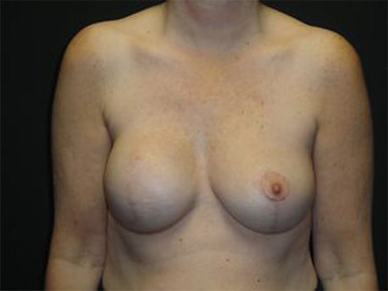 Breast Implant Reconstruction Before & After Gallery - Patient 167367538 - Image 2