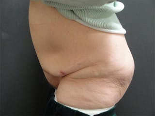 Body Reconstruction Before & After Gallery - Patient 167367539 - Image 4