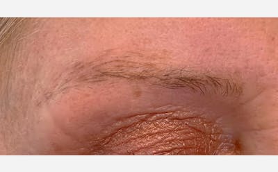 Microblading Before & After Gallery - Patient 167367537 - Image 1