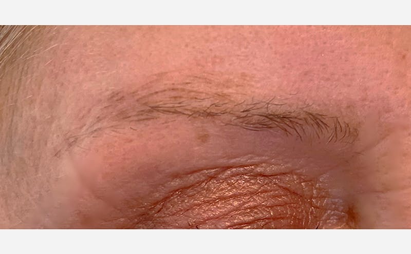 Microblading Before & After Gallery - Patient 167367537 - Image 1