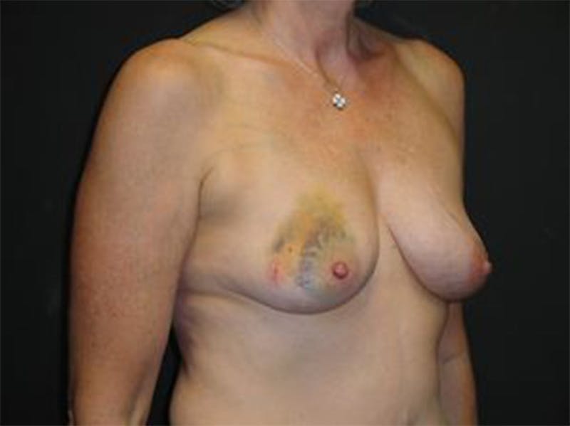 Breast Implant Reconstruction Before & After Gallery - Patient 167367538 - Image 3