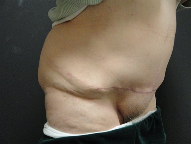 Body Reconstruction  Before & After Gallery - Patient 167367539 - Image 6