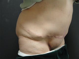 Body Reconstruction Before & After Gallery - Patient 167367539 - Image 6