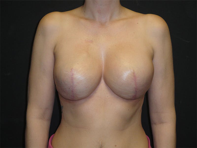 Breast Implant Reconstruction Before & After Gallery - Patient 167367543 - Image 2